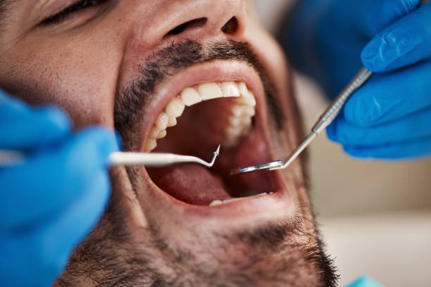 Best Emergency Wisdom Teeth Removal in Elyria, OH
